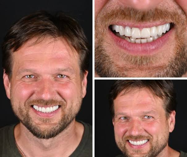 Full Zirconia med ytporslin